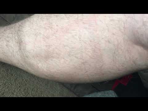 Muscle Twitching Benign fasciculation syndrome BFS