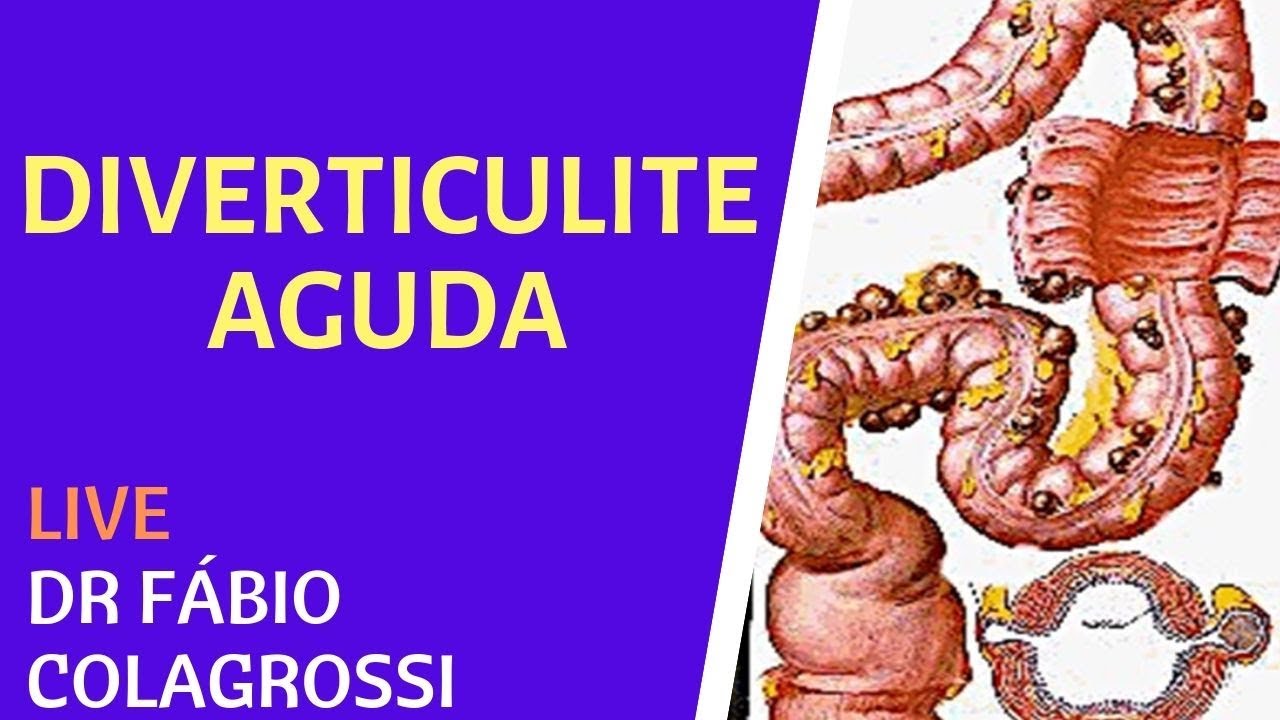 DIVERTICULITE AGUDA - LIVE