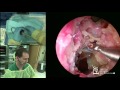 Orbital & Optic Nerve Decompression, Endoscopic DCR Demonstration by Greg Davis, MD