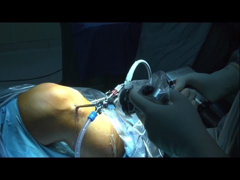 Gamba dolorante con il trattamento di ernia spinale Perchè fa male sul lato sinistro della schiena sopra la vita