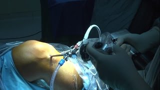 Intervento ricostruttivo LCA con tecnica LARS (Video completo HD)