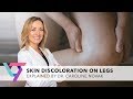 Medical Center: Skin Discoloration on Legs | Best Vein Doctor in New York 10016