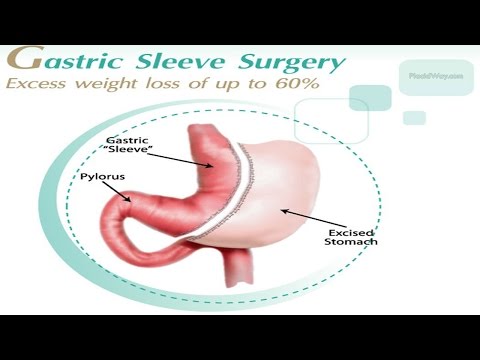 Best Gastric Sleeve Surgery in Mexico: Your Guide to a Healthier Future