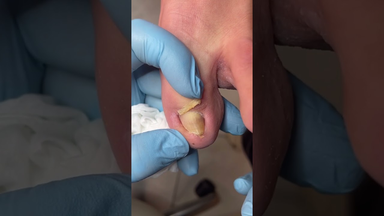 Satisfying Toenail Grooming | Gentle Foot Care Routine  #fypシ #cleannails #RelaxingCare #fypシ