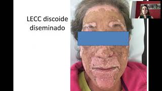 Manifestaciones cutáneas de las enfermedades Autoinmunes Sistémicas