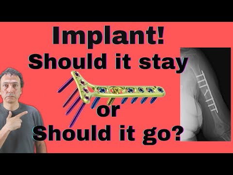 Should the implants be removed after the fracture healed?
