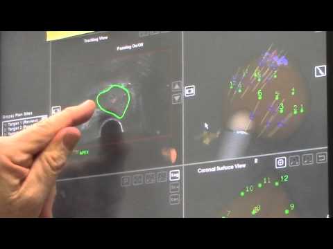 ARTEMIS Provides New Prostate Cancer Diagnosis Tool Part 3