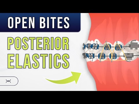Anterior OPEN BITE - Posterior Elastics | Orthodontic Treatment