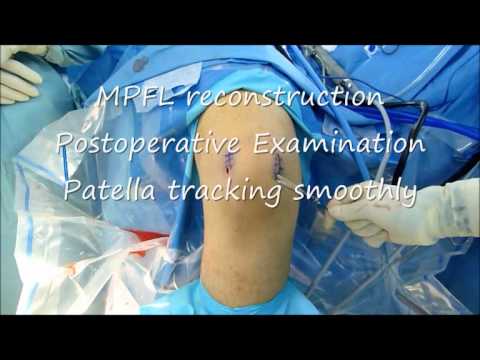 MPFL Correction In Kneecup Displacement