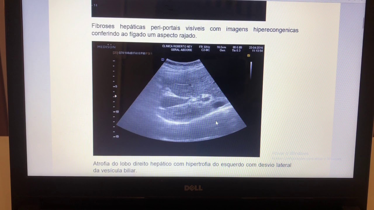 Patologia da esquistossomose