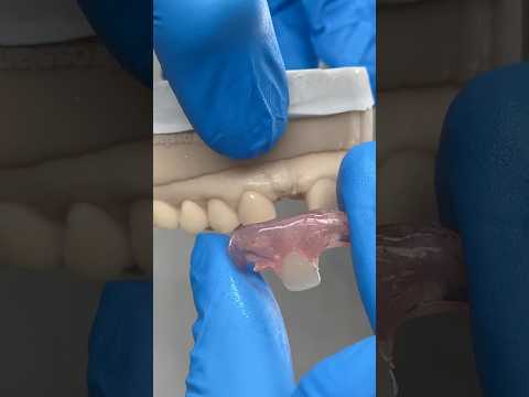 Lateral Nesbit @EnvisiontecMain #envisiontec #dental #teeth #smile #lsk121shorts #shortvideo