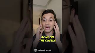 Getting acne on specific areas of the face?? || Dr Ankur Sarin ||