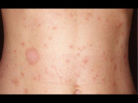 Pityriasis Rosea 101