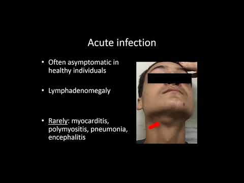 Ocular Toxoplasmosis: Dr.João M. Furtado