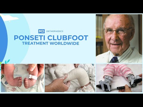 , title : 'Ponseti Clubfoot Treatment Worldwide - Feature Length Documentary'