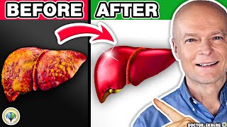 #1 Absolute Best FATTY LIVER DETOX