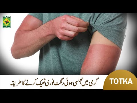 How To Remove Sun Tanning | Sun Burning Skin Treatment | SunBurn Home Remedy | MasalaTv