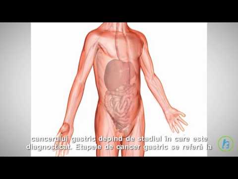 Cancer de colon etapas y sintomas
