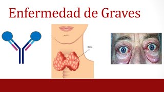 ¿Qué es la enfermedad de Graves?