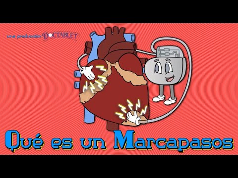 Qué es un Marcapasos, Marcapasos sin Cables, Resincronización Cardíaca
