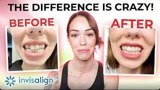 I finished Invisalign & my teeth aren’t straight.. yet