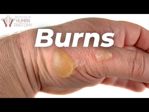 Skin Burns A LOT Faster Than You Think...