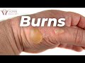 Skin Burns A LOT Faster Than You Think...