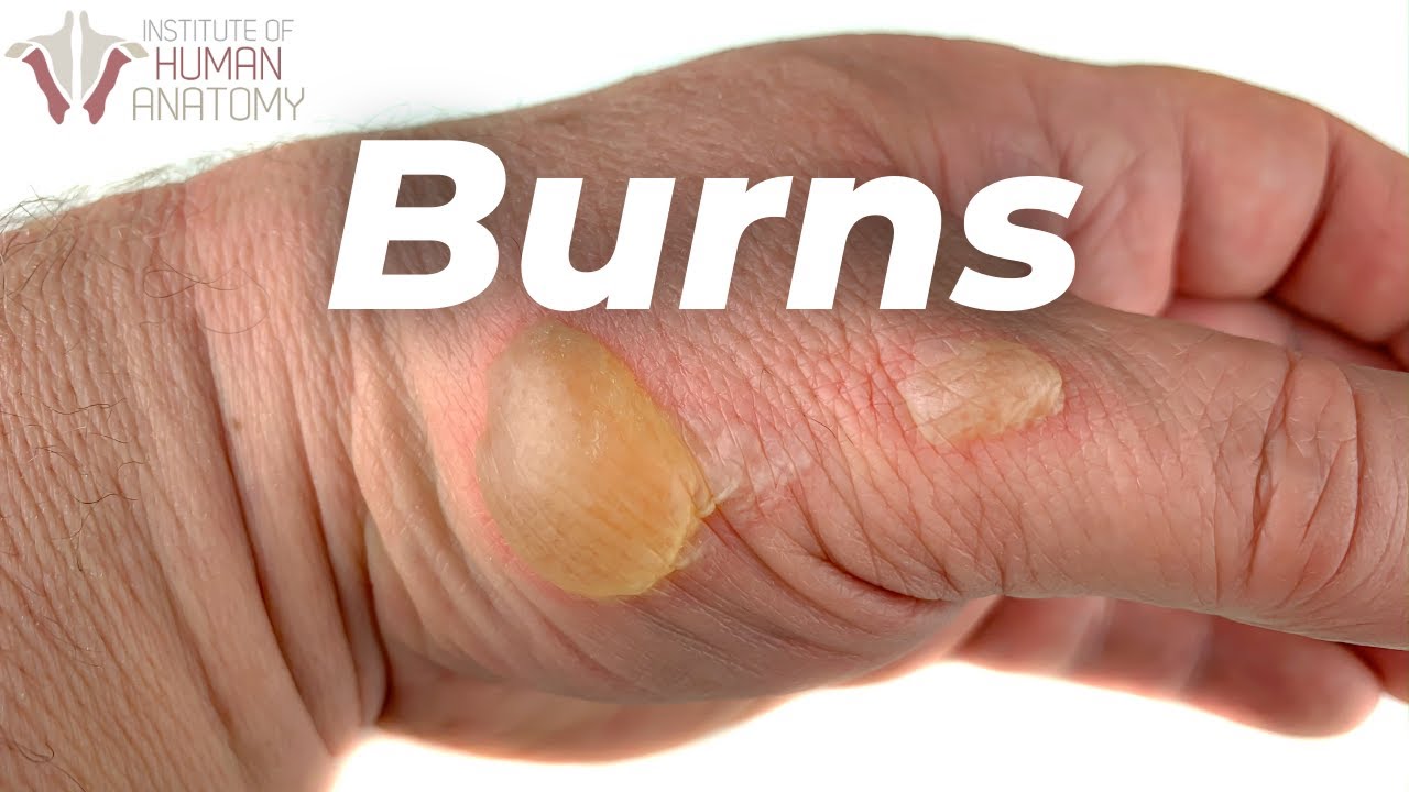 What happens when you burn your epidermis? Tipseri