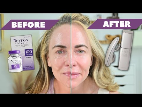 MICROCURRENT FACIAL | 微電流會毀掉肉毒桿菌嗎 | ZIIP Halo 評論 (MICROCURRENT FACIAL | Does Microcurrent Ruin Botox | ZIIP Halo Review)