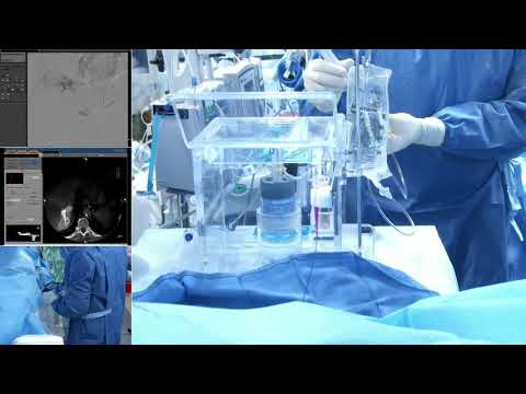 Transradial Y90 Segmentectomy Radioembolization for Hepatocellular Carcinoma (HCC) with Theraspheres