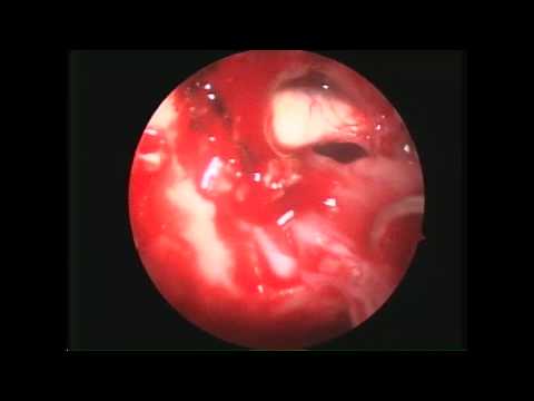 Endoscopic transsphenoidal extended approach for the resection of craniopharyngioma