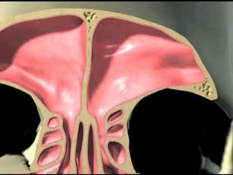 Balloon Sinuplasty and FESS Animation