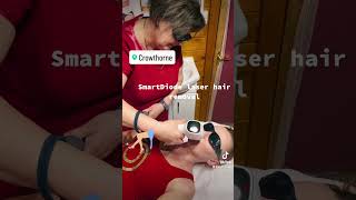 SmartDiode laser hair removal