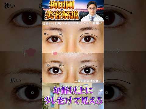 医学科 他院の二重修正│若々しくみえる二重とは？ #うめだ美容外科クリニック #二重 #吊り上げ縫合