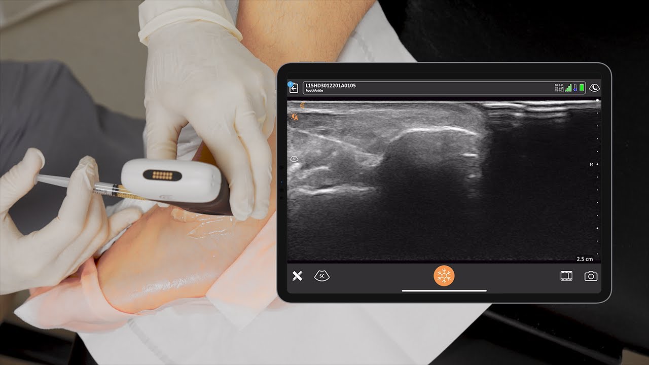 PRP Ankle Injections