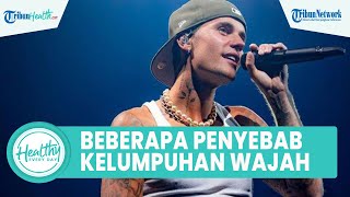 Inilah Penyebab Lumpuh Separuh Wajah yang Dialami Justin Bieber, Salah Satunya Akibat Bell’s Palsy
