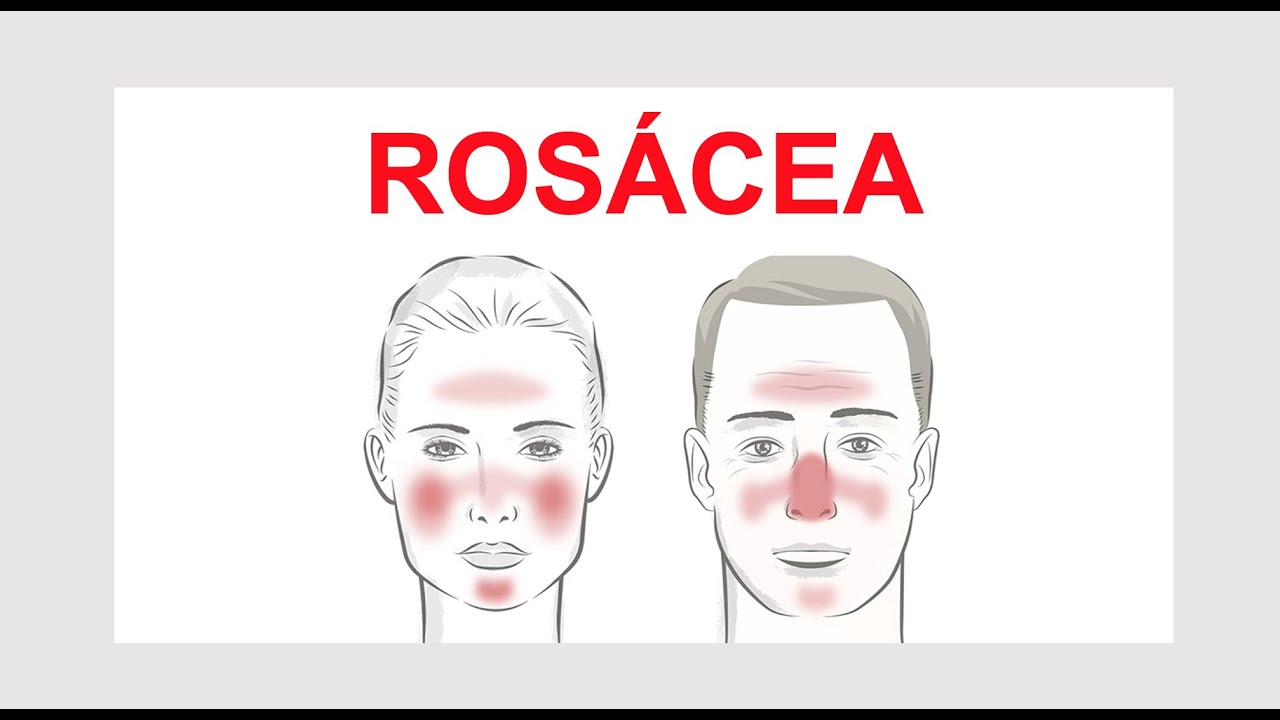 ROSÁCEA - O que é? Como controlar? Por Luiz Gameiro, dermatologista