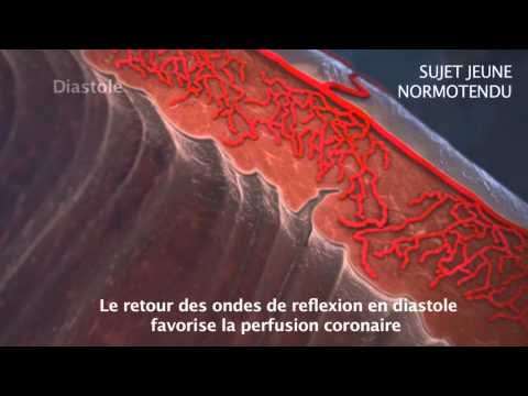 Racine de gingembre à la pression artérielle Cardiopsychoneurosis de la CIM-10 de type hypertensive