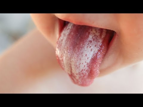 Thrush in babies