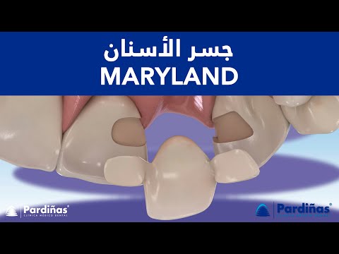 © جسر الأسنان للأسنان المفقودة MARYLAND