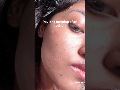 How I repair my dry irritated skin after tretinoin/retinol ✨ #acne #skincaretips #glassskin
