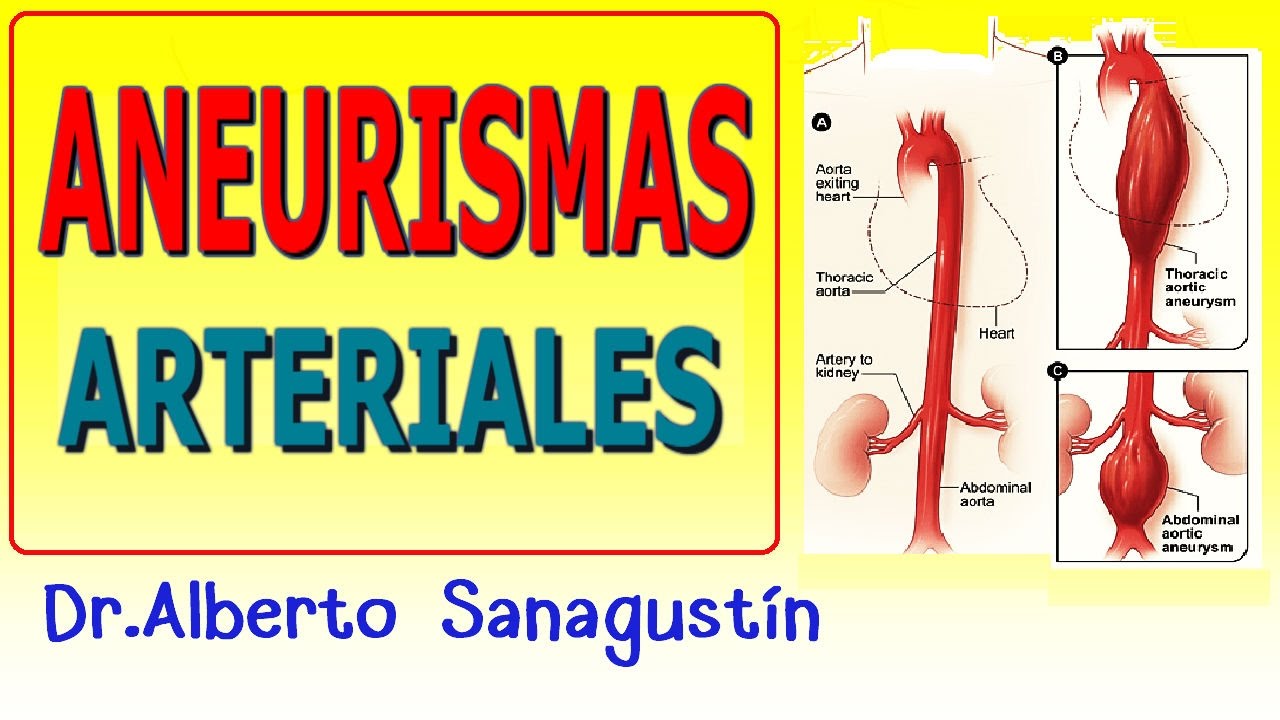 ANEURISMAS (CEREBRAL, AÓRTICO Y ABDOMINAL)