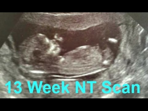 70% Chance it's a GIRL! 13 Week NT Ultrasound Scan