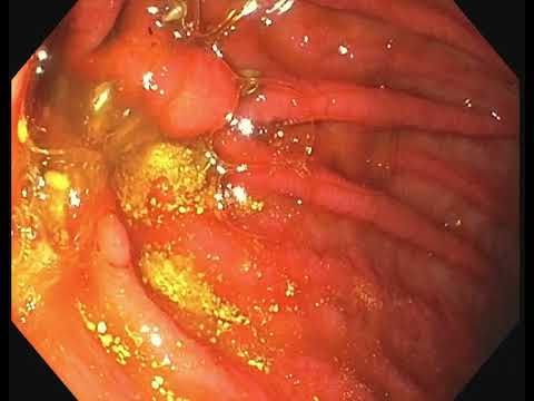 Żółciowe zapalenie błony śluzowej żołądka