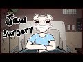 I Had My Jaw Wired Shut For 2 Months