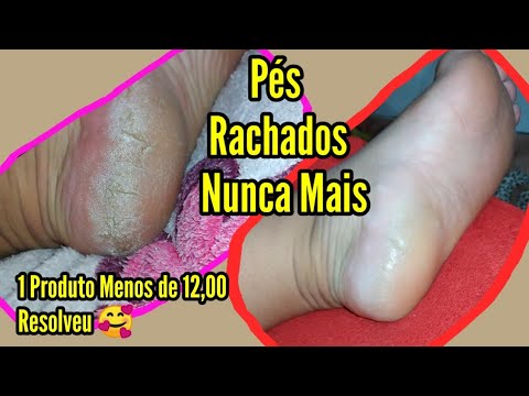 Como Recuperei Meus Pés Rachados