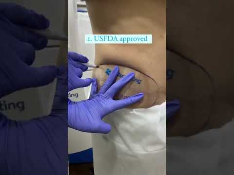 Say goodbye to love handles with Coolsculpting