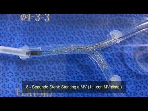 Técnicas en Bifurcaciones: Inverted Culotte In Vitro