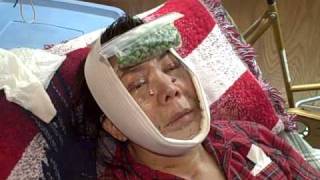 My Complete Facial Plastics Rejuvenation Video Blog & Diary 02