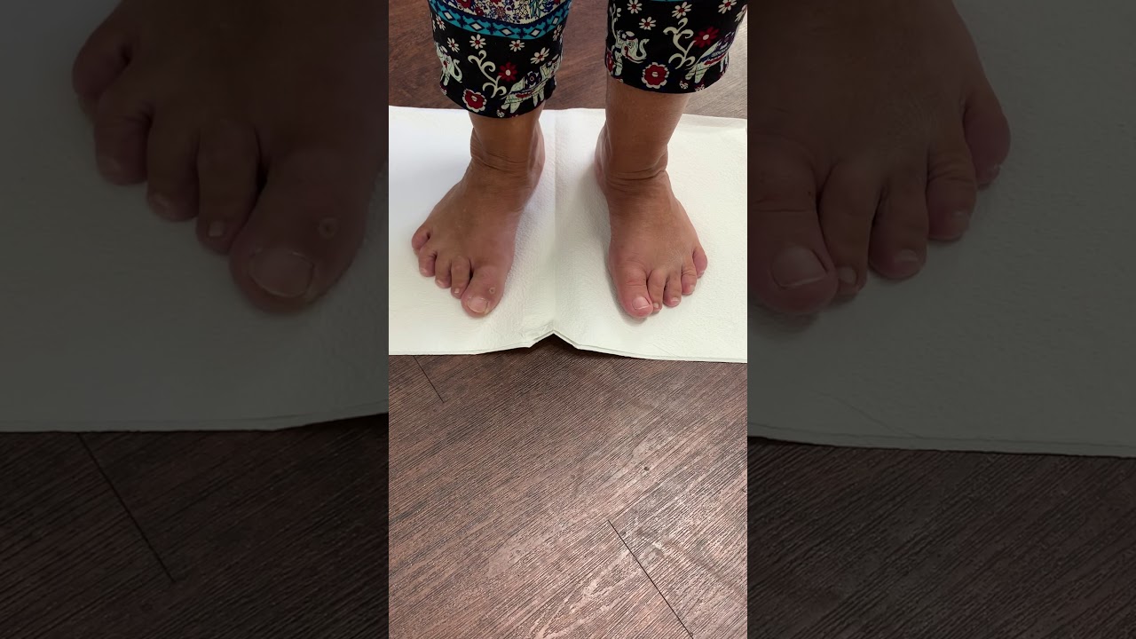 CIRUGÍA MÍNIMAMENTE INVASIVA PARA EL DEDO DE MARTILLO, JUANETE Y LA ARTRITIS 👣😄👣😄👣